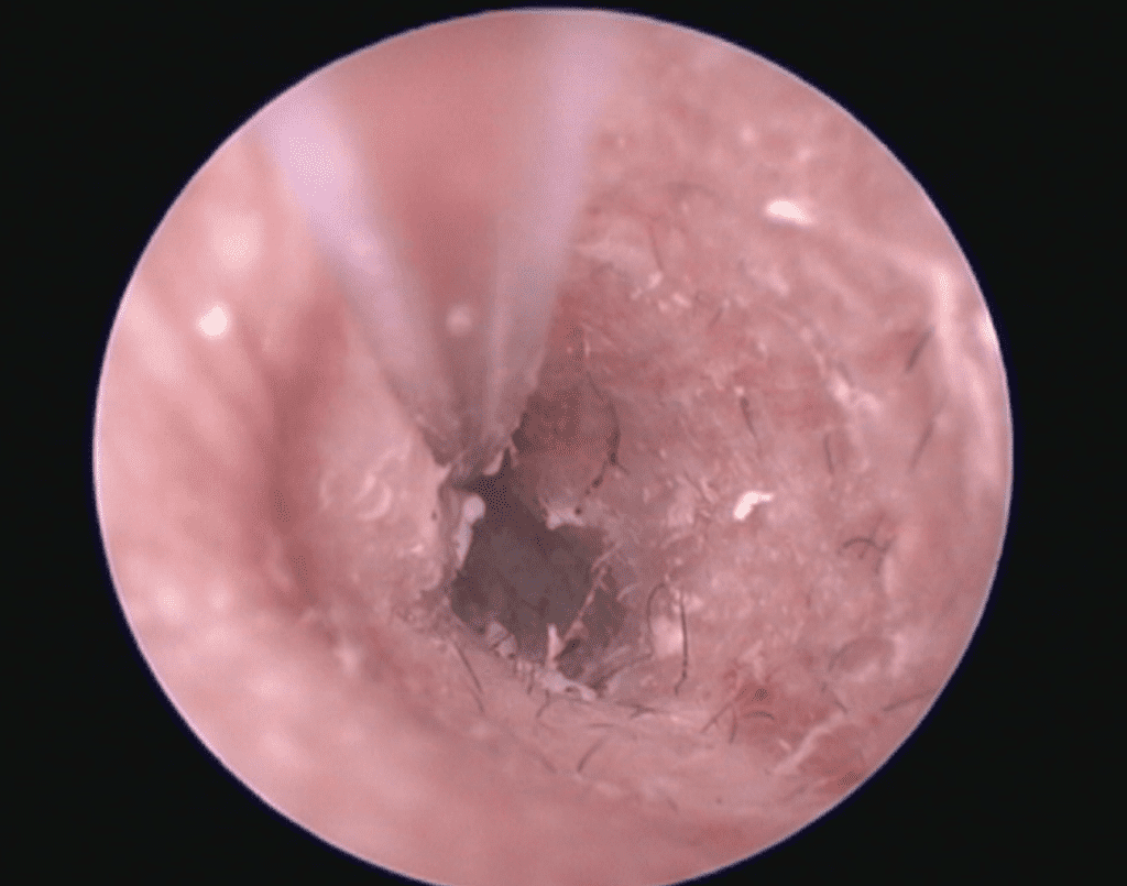 Videotoendoscopia